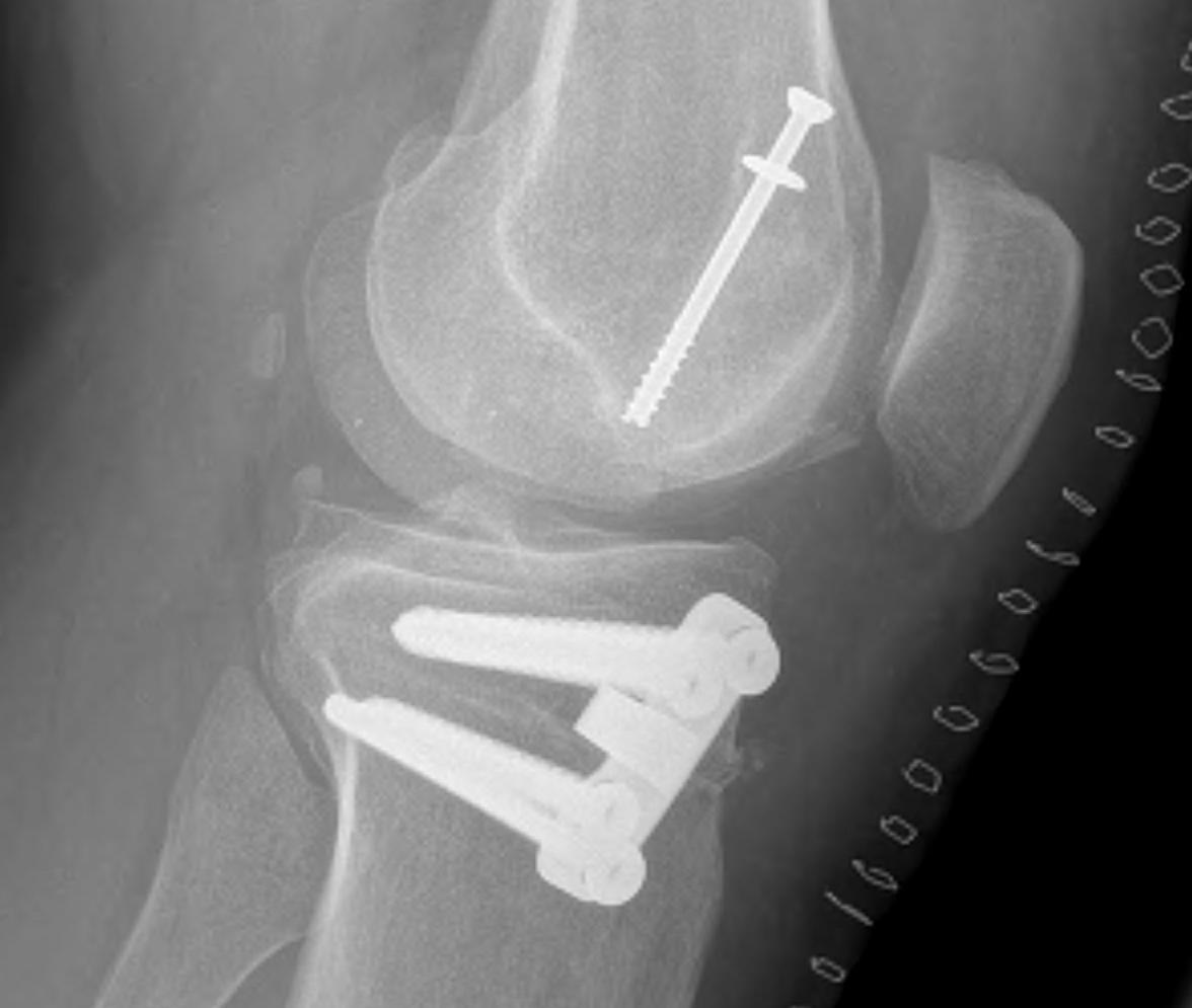 Osteochondral Allograft Lateral